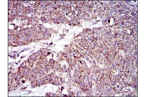 Immunohistochemical analysis of paraffin-embedded esophageal cancer tissues using MRPL42 mouse mAb with DAB staining. (MRPL42 Antikörper  (AA 142-203))