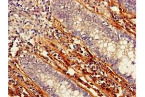 Immunohistochemistry of paraffin-embedded human colon cancer using ABIN7165903 at dilution of 1:100 (Patched 1 Antikörper  (AA 1180-1411))