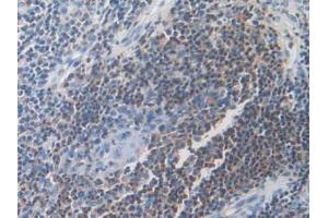 IHC-P analysis of Human Skin Cancer Tissue, with DAB staining. (DOK3 Antikörper  (AA 128-385))