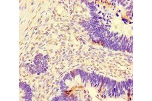 Immunohistochemistry of paraffin-embedded human ovarian cancer using ABIN7150550 at dilution of 1:100 (DNAJC3 Antikörper  (AA 277-496))