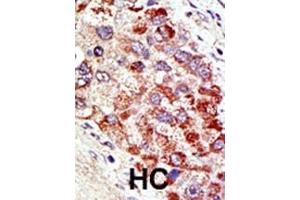 Formalin-fixed and paraffin-embedded human cancer tissue reacted with the primary antibody, which was peroxidase-conjugated to the secondary antibody, followed by AEC staining. (CBLC Antikörper  (N-Term))