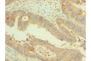 Immunohistochemistry of paraffin-embedded human colon cancer using ABIN7162499 at dilution of 1:100 (PAX4 Antikörper  (AA 50-200))