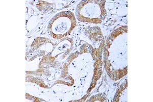 Immunohistochemical analysis of TRADD staining in human colon cancer formalin fixed paraffin embedded tissue section. (TRADD Antikörper  (C-Term))