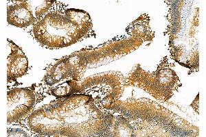ABIN6264411 and ABIN6276954 at 1/100 staining Human colorectal cancer by IHC-P. (Peroxiredoxin 2 Antikörper  (C-Term))