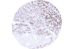 Kidney Clear cell renal cell carcinoma showing moderate to strong Melan A immunostaining of tumor cells (Rekombinanter MLANA Antikörper)
