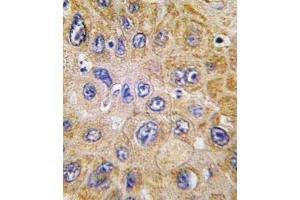 Formalin-fixed and paraffin-embedded human hepatocarcinoma tissue reacted with THY1 antibody , which was peroxidase-conjugated to the secondary antibody, followed by DAB staining. (CD90 Antikörper  (N-Term))