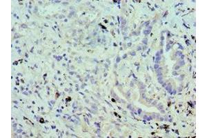 Immunohistochemistry of paraffin-embedded human lung cancer using ABIN7174459 at dilution of 1:100 (UBE2J2 Antikörper  (AA 1-230))