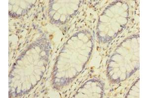 Immunohistochemistry of paraffin-embedded human colon cancer using ABIN7147425 at dilution of 1:100 (Cep76 Antikörper  (AA 241-550))