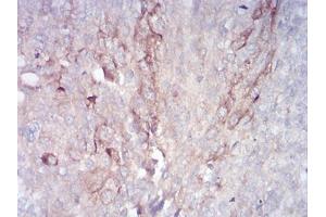 Immunohistochemical analysis of paraffin-embedded bladder cancer tissues using RAB11FIP1 mouse mAb with DAB staining. (RAB11FIP1 Antikörper  (AA 130-271))
