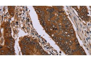 Immunohistochemistry of paraffin-embedded Human colon cancer using Catenin gamma Polyclonal Antibody at dilution of 1:40 (JUP Antikörper)