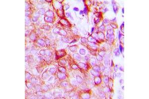 Immunohistochemical analysis of LPHN2 staining in human breast cancer formalin fixed paraffin embedded tissue section. (LPHN2 Antikörper  (Center))