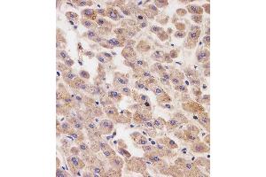 (ABIN6242760 and ABIN6577246) staining AFP in human liver tissue sections by Immunohistochemistry (IHC-P - paraformaldehyde-fixed, paraffin-embedded sections). (alpha Fetoprotein Antikörper  (AA 281-609))