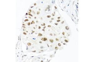 Immunohistochemistry of paraffin-embedded human lung cancer using THOC1 antibody (ABIN5974800) at dilution of 1/100 (40x lens). (THOC1 Antikörper)