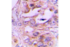 Immunohistochemical analysis of NDRG2 staining in human lung cancer formalin fixed paraffin embedded tissue section. (NDRG2 Antikörper  (Center))