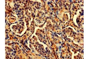 IHC image of ABIN7164696 diluted at 1:200 and staining in paraffin-embedded human lung cancer performed on a Leica BondTM system. (PDCD6 Antikörper  (AA 1-191))