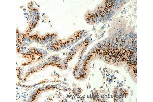 Immunohistochemistry of Human gastric cancer using TRPC6 Polyclonal Antibody at dilution of 1:40 (TRPC6 Antikörper)