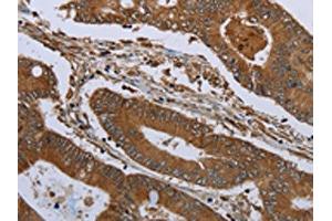 The image on the left is immunohistochemistry of paraffin-embedded Human colon cancer tissue using ABIN7191233(KLRF1 Antibody) at dilution 1/30, on the right is treated with synthetic peptide. (KLRF1 Antikörper)