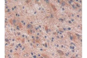 DAB staining on IHC-P; Samples: Human Glioma Tissue (Reelin Antikörper  (AA 26-190))