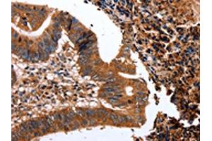 The image on the left is immunohistochemistry of paraffin-embedded Human colon cancer tissue using ABIN7128966(CLEC4A Antibody) at dilution 1/15, on the right is treated with fusion protein. (CLEC4A Antikörper)