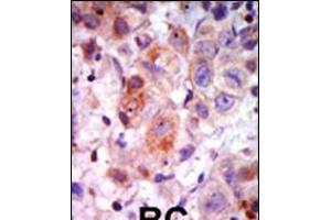 Formalin-fixed and paraffin-embedded human cancer tissue reacted with the primary antibody, which was peroxidase-conjugated to the secondary antibody, followed by AEC staining. (GRK2 Antikörper  (C-Term))
