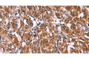 Immunohistochemistry of paraffin-embedded Human thyroid cancer tissue using TDP2 Polyclonal Antibody at dilution 1:40 (TDP2 Antikörper)