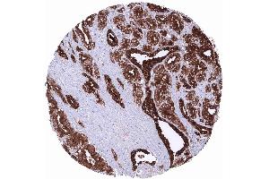 Prostate Adenocarcinoma Gleason 336 showing strong PSA positivity of tumor cells (Rekombinanter Prostate Specific Antigen Antikörper  (AA 150-250))