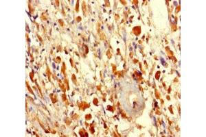 Immunohistochemistry of paraffin-embedded human melanoma using ABIN7165358 at dilution of 1:100 (FAM114A2 Antikörper  (AA 1-505))