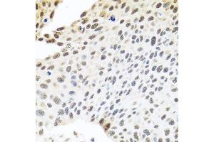 Immunohistochemistry of paraffin-embedded human lung cancer using SKIV2L2 antibody.