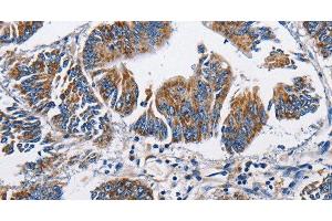 Immunohistochemistry of paraffin-embedded Human colon cancer tissue using NPPA Polyclonal Antibody at dilution 1:60 (NPPA Antikörper)