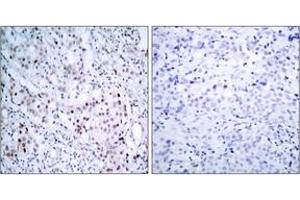 Immunohistochemistry analysis of paraffin-embedded human breast carcinoma, using c-Jun (Phospho-Ser63) Antibody. (C-JUN Antikörper  (AA 31-80))