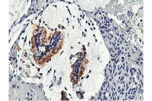 Immunohistochemical staining of paraffin-embedded Adenocarcinoma of Human colon tissue using anti-CAPN9 mouse monoclonal antibody. (Calpain 9 Antikörper)