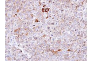 IHC-P Image Immunohistochemical analysis of paraffin-embedded CL1-0 xenograft , using Synaptophysin, antibody at 1:100 dilution.