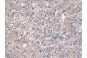 Detection of VEGF121 in Human Lung cancer Tissue using Monoclonal Antibody to Vascular Endothelial Growth Factor 121 (VEGF121)