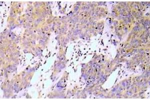 Immunohistochemistry (IHC) analyzes of NFkB-p65 pAb in paraffin-embedded human lung adenocarcinoma tissue. (NF-kB p65 Antikörper)