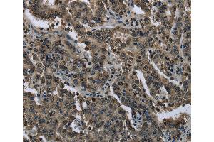 Immunohistochemistry of Human liver cancer using FTO Polyclonal Antibody at dilution of 1:60 (FTO Antikörper)