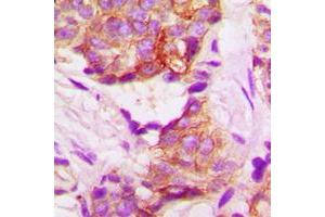 Immunohistochemical analysis of TACSTD2 staining in human lung cancer formalin fixed paraffin embedded tissue section.