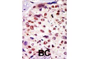 Formalin-fixed and paraffin-embedded human breast cancer tissue reacted with BAI1 polyclonal antibody  , which was peroxidase-conjugated to the secondary antibody, followed by AEC staining.
