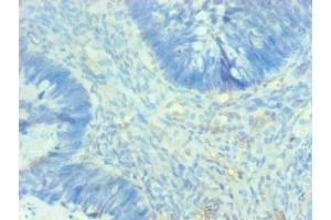 Immunohistochemical of paraffin-embedded human breast cancer using ABIN7143609 at dilution of 1:200 (Fetuin A Antikörper)