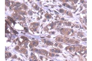 DAB staining on IHC-P; Samples: Human Breast cancer Tissue (PPP1CA Antikörper  (AA 2-330))