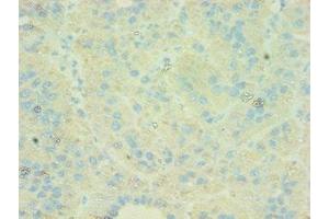 Immunohistochemistry of paraffin-embedded human liver cancer using ABIN7146169 at dilution of 1:100 (C4BPB Antikörper  (AA 18-252))