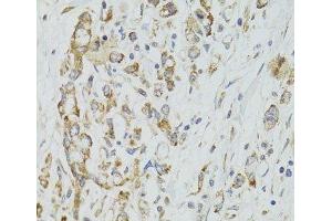 Immunohistochemistry of paraffin-embedded Human gastric cancer using DICER1 Polyclonal Antibody at dilution of 1:100 (40x lens). (DICER1 Antikörper)