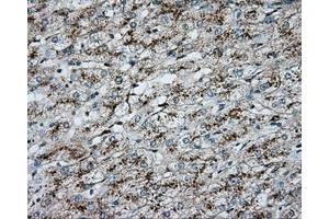 Immunohistochemical staining of paraffin-embedded Carcinoma of liver tissue using anti-ERCC1 mouse monoclonal antibody. (ERCC1 Antikörper)