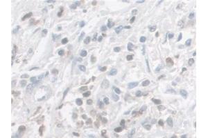 Detection of GAL9 in Human Prostate cancer Tissue using Polyclonal Antibody to Galectin 9 (GAL9) (Galectin 9 Antikörper  (AA 1-323))
