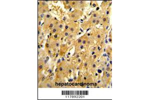 Formalin-fixed and paraffin-embedded human hepatocarcinoma reacted with HPD Antibody (N-term), which was peroxidase-conjugated to the secondary antibody, followed by DAB staining.