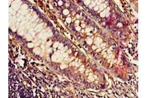 Immunohistochemistry of paraffin-embedded human colon cancer using ABIN7159128 at dilution of 1:100 (MED23 Antikörper  (AA 1014-1368))