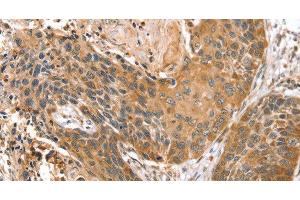 Immunohistochemistry of paraffin-embedded Human esophagus cancer using STX10 Polyclonal Antibody at dilution of 1:45 (Syntaxin 10 Antikörper)