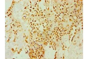 Immunohistochemistry of paraffin-embedded human breast cancer using ABIN7149658 at dilution of 1:100 (Seladin 1 Antikörper  (AA 227-516))
