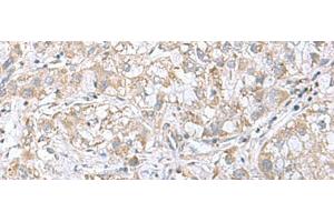 Immunohistochemistry of paraffin-embedded Human liver cancer tissue using CGB5 Polyclonal Antibody at dilution of 1:55(x200) (CGB5 Antikörper)