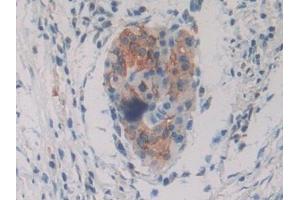 Detection of PKIg in Human Pancreatic cancer Tissue using Polyclonal Antibody to Protein Kinase Inhibitor Gamma (PKIg) (PKIG Antikörper  (AA 1-76))