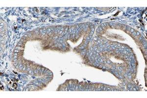 ABIN6279733 at 1/100 staining Human cervical cancer tissue by IHC-P. (RAB24 Antikörper  (Internal Region))